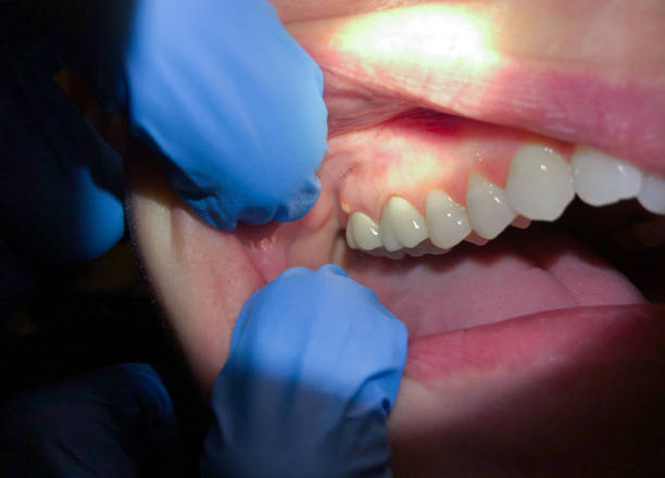 Best Emergency Dentist for Knocked-Out Tooth in Summerfield, NC